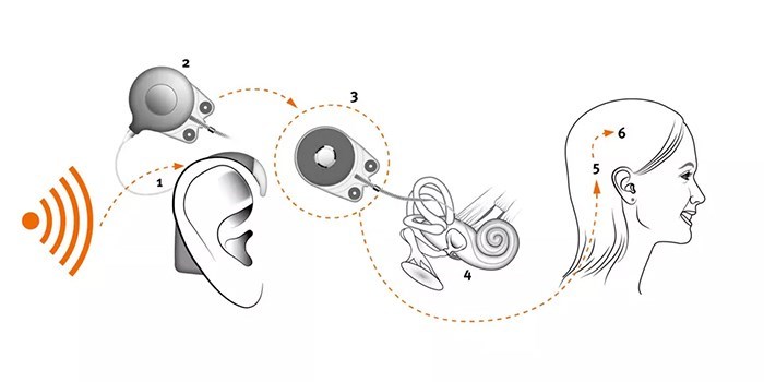 Cochlear implant. Credit Oticon Medicial. 1. The sound processor captures and digitizes sound.  2. The antenna is magnetically attached to the skin and transmits the digitized sound from the sound processor to the implant receiver.  3. The magnetic implant receiver is fitted under the skin directly under the antenna. It transforms the digital information into an electronic signal sent to the cochlea.  4. The electrode array is inserted in the cochlea. Each electrode on the array corresponds to a signal frequency.  5. When the encoded signal is transmitted to the corresponding electrode, the auditory nerve is stimulated.  6. The brain receives the sound transmitted via the auditory nerve.